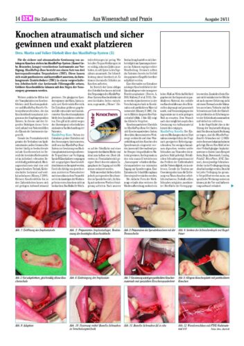 FB | MaxilloPrep System Teil 3
