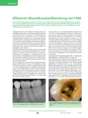 FB | Effiziente Wurzelkanalaufbereitung mit F360