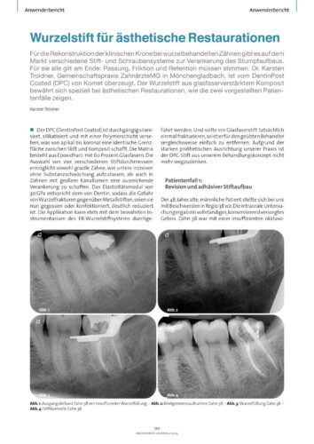 FB | Wurzelstift für ästhetische Restaurationen