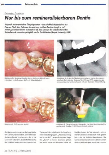 FB | Nur bis zum remineralisierbaren Dentin