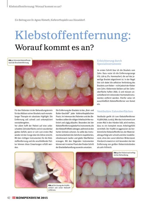 FB | Klebstoffentfernung