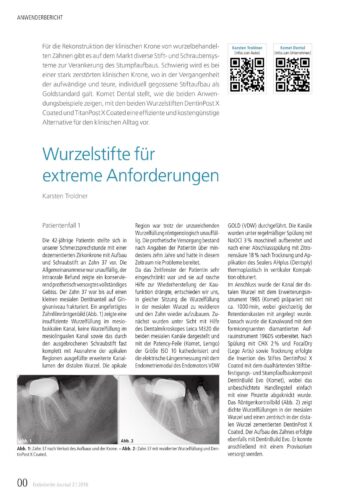 FB | Wurzelstift für extreme Anforderungen