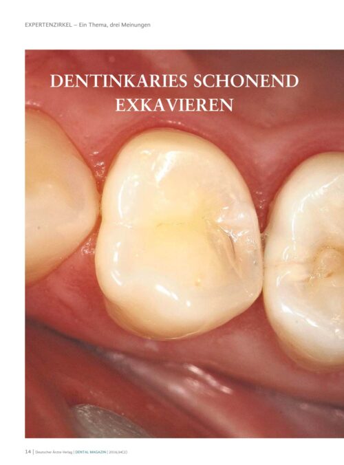 FB | Dentinkaries schonend exkavieren