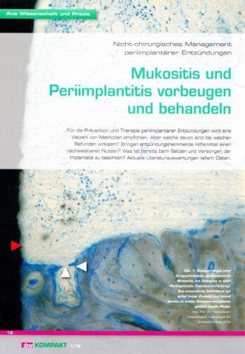 FB | Mukositis und Periimplantitis vorbeugen und behandeln
