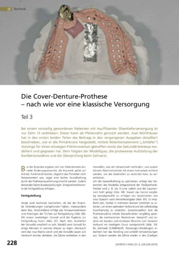 FB | Die Cover-Denture-Prothese Teil 3