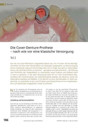FB | Die Cover-Denture-Prothese Teil 2