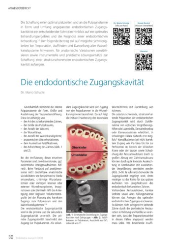 FB | Die endodontische Zugangskavität