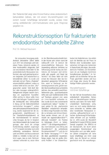 FB | Rekonstruktionsoption für frakturierte endodontisch behandelte Zähne