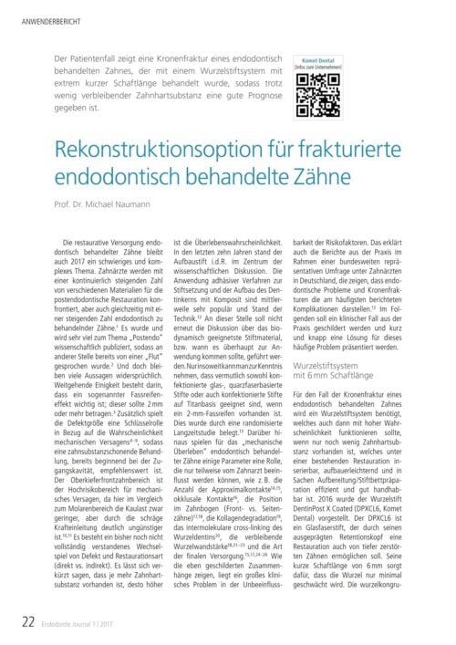 FB | Rekonstruktionsoption für frakturierte endodontisch behandelte Zähne