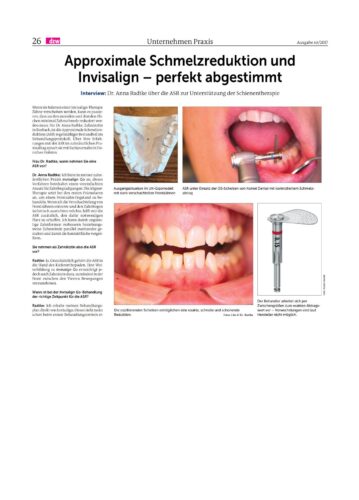 FB | Approximale Schmelzreduktion und Invisalign - perfekt abgestimmt