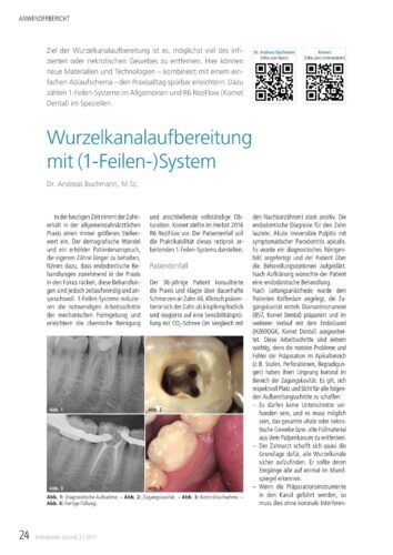FB | Wurzelkanalaufbereitung mit (1-Feilen-)System