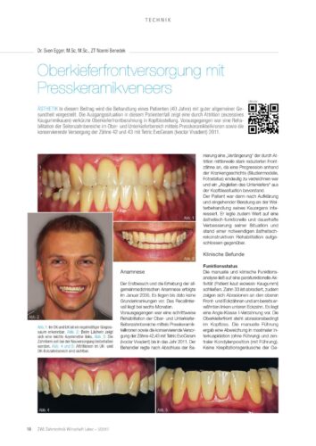 FB | Oberkieferfrontversorgung mit  Presskeramikveneers