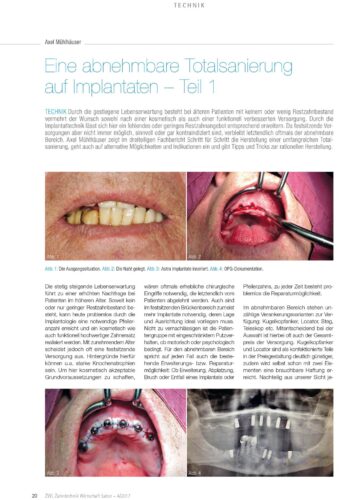 FB | Eine abnehmbare Totalsanierung auf Implantaten - Teil 1