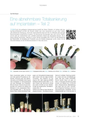 FB | Eine abnehmbare Totalsanierung auf Implantaten - Teil 2