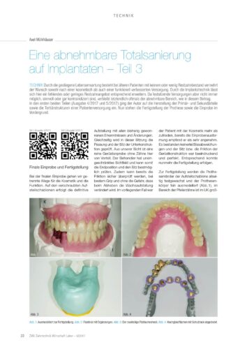 FB | Eine abnehmbare Totalsanierung auf Implantaten - Teil 3