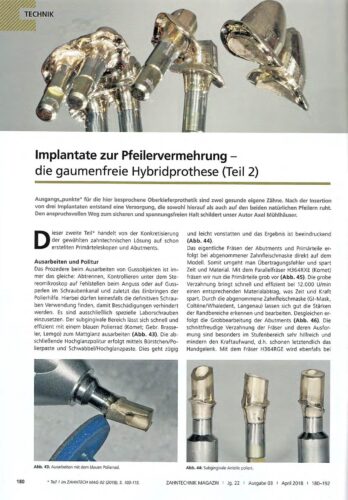 FB | Implantate zur Pfeilervermehrung - die gaumenfreie Hybridprothese (Teil 2)