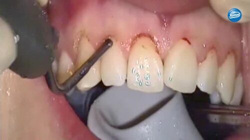 Video | chirurgische Kronenverlängerung klinische Sequenz