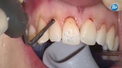 Видео | Surgical crown extension Clinical sequence