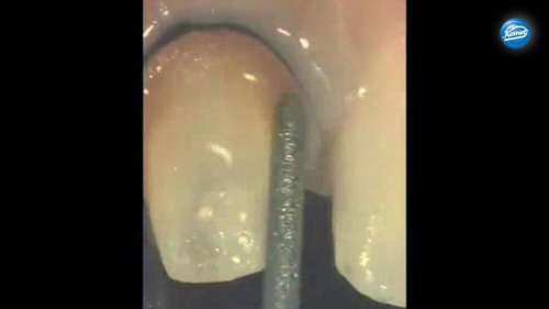 Video | Preparation of crown cores while conserving the periodontium