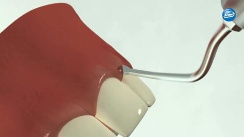 Video |  chirurgische Kronenverlängerung schematische Darstellung