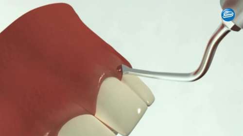 Vidéo | Elongation coronaire chirurgicale Représentation schématique