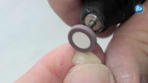 Filmato | Lucidatura di una corona rivestita con facceta di ceramica