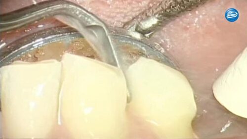 Video | Kronenstumpfpräparation SonicLine