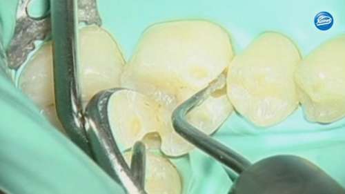 Video | Cavity preparation, Dr. Agabiti Italien, Komet SonicLine