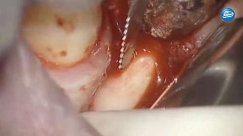 Video | Harvesting intra-oral bone grafts