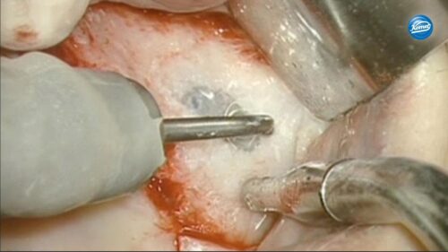 Video | Externer Sinuslift mit Schallspitzen