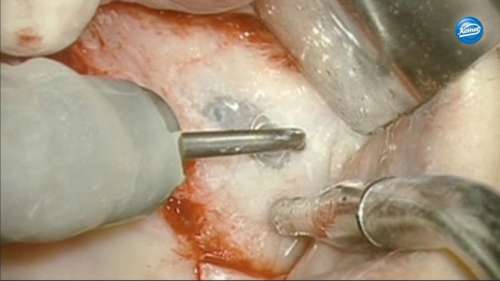 Видео | Open sinus lift with sonic tips