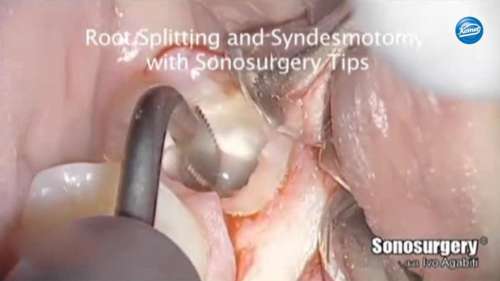 Video | Removal of a wisdom tooth, Dr. Agabiti, Italy