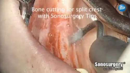 Video | Split Crest, Dr. Agabiti, Italy
