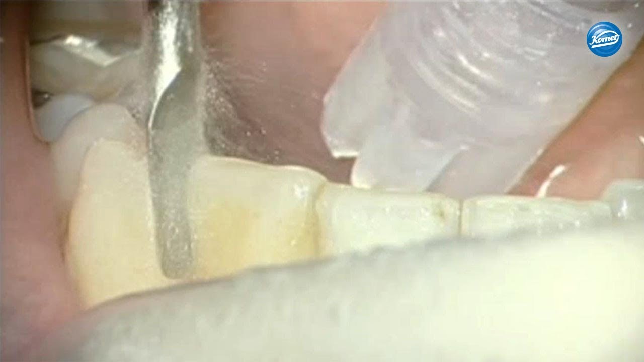 Video IPR as part of an orthodontic treatment › Komet Dental