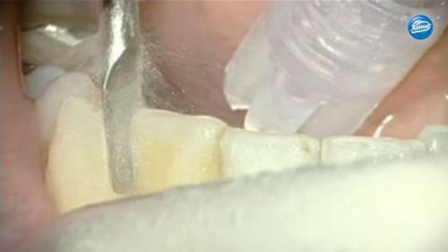 Filmato | Riduzione prossimale dello smalto nel corso di un trattamento ortodontico