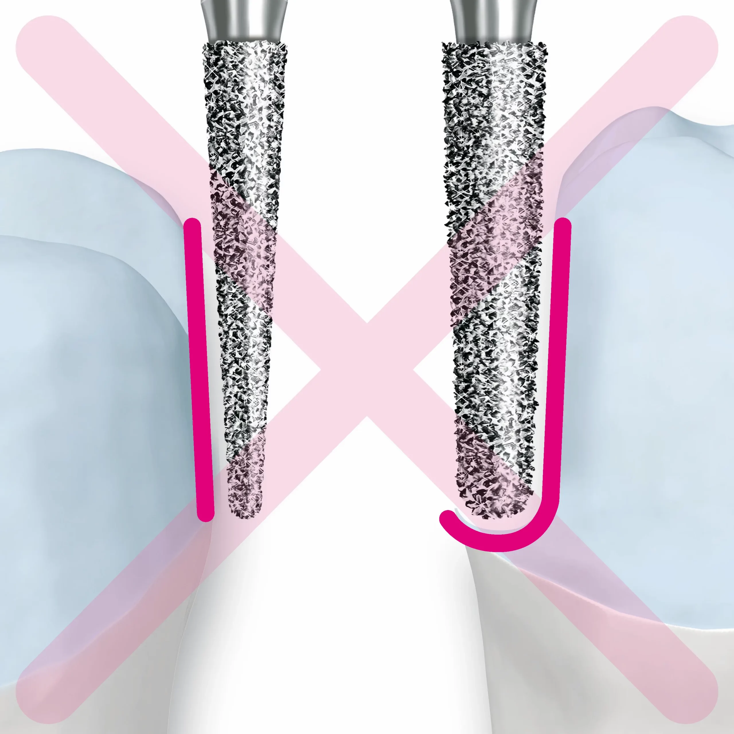 Most important rules to be observed during preparations for all cermaic crowns