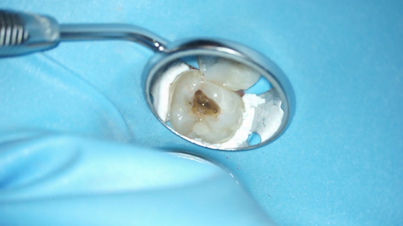 Fq Files Case study: Endodontic treatments with Komet's FQ File System – Komet ...