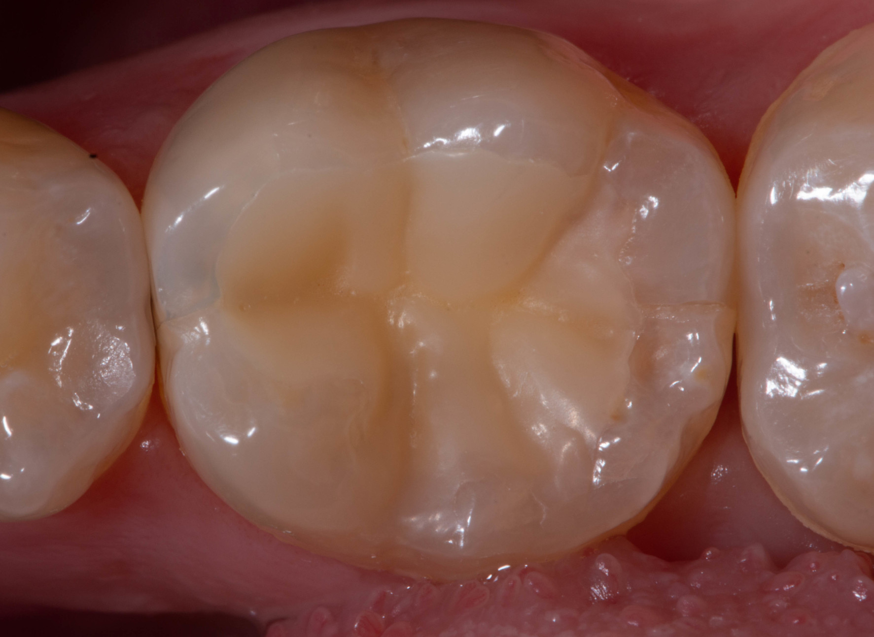 biorepair-filling biorepair-filling