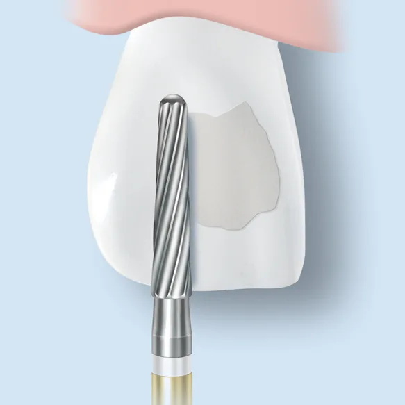 Addhesive remover for labial surfaces