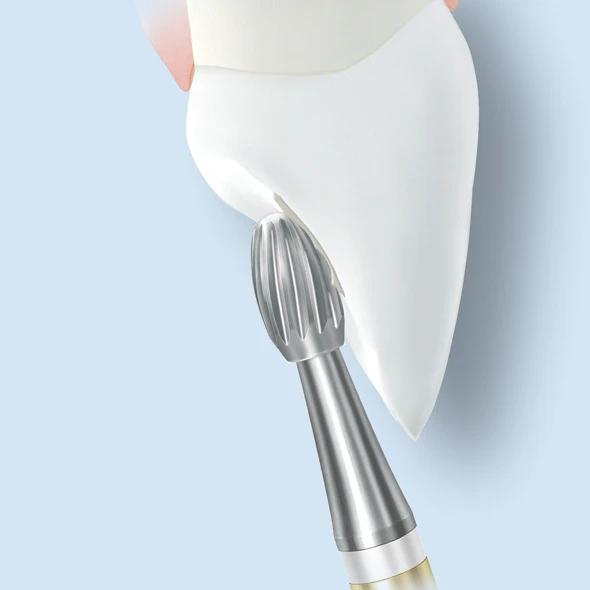 Addhesive remover for lingual surfaces