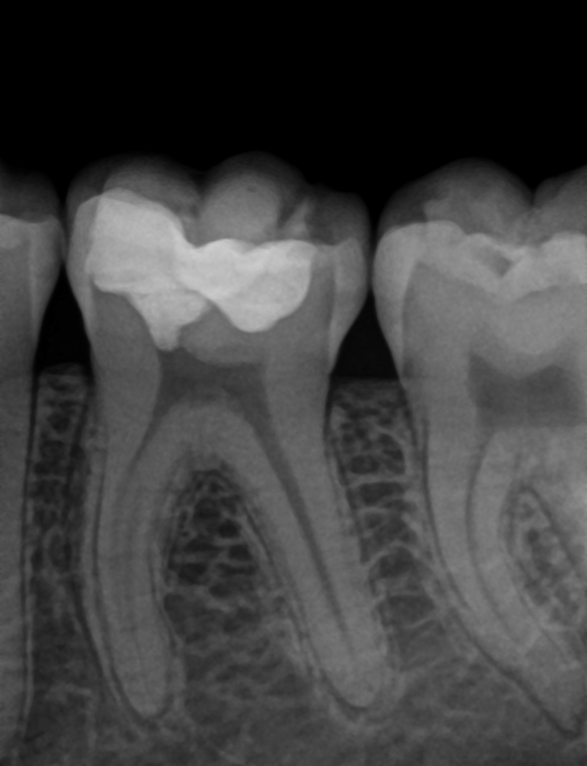 tooth no. 36 30.10.2023 tooth no. 36 30.10.2023